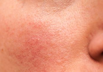 Natural Ways To Get Rid Of A Red Face